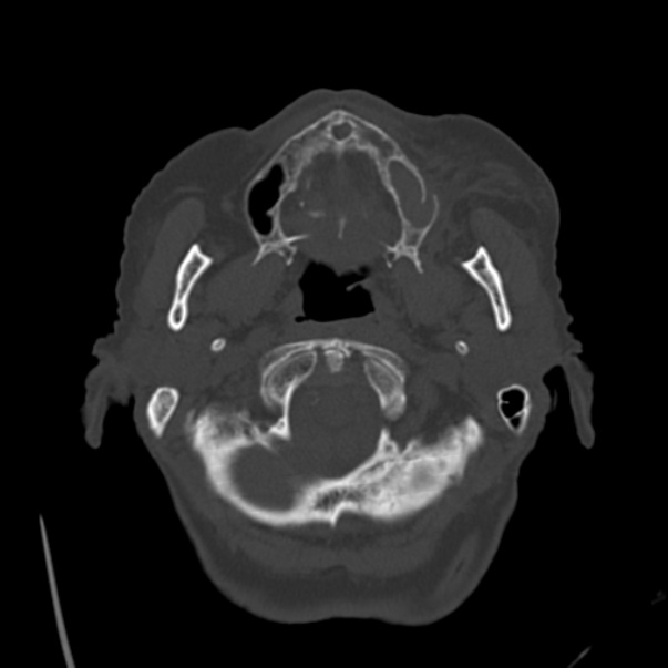 Biparietal osteodystrophy (Radiopaedia 46109-50463 bone window 8).jpg