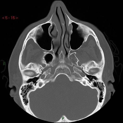 Bisphosphonate-related osteonecrosis of the jaw (Radiopaedia 54147-60329 Axial bone window 9).jpg
