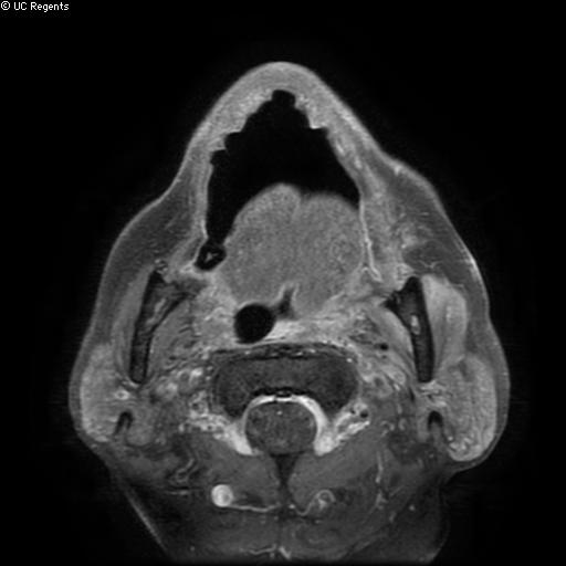 Bisphosphonate-related osteonecrosis of the maxilla (Radiopaedia 51367-57101 Axial T1 C+ fat sat 12).jpg