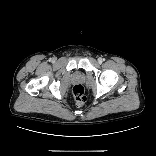 Blunt abdominal trauma with solid organ and musculoskelatal injury with active extravasation (Radiopaedia 68364-77895 A 153).jpg