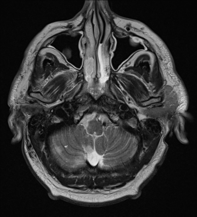 File:Blunt cerebrovascular injury (Radiopaedia 53682-59745 Axial T2 5).png