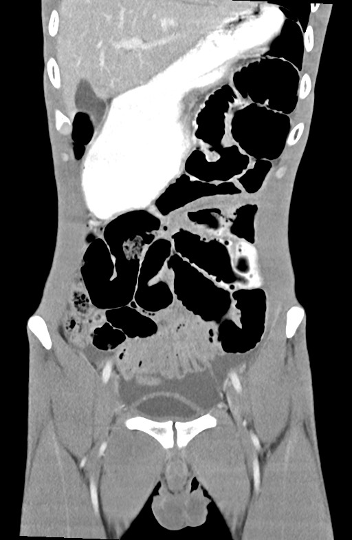 Blunt injury to the small bowel (Radiopaedia 74953-85987 B 29).jpg