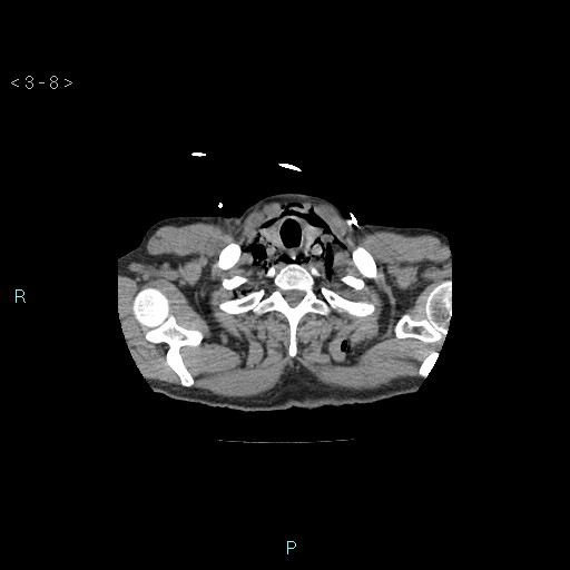 Boerhaave syndrome (Radiopaedia 27683-27897 Axial non-contrast 8).jpg
