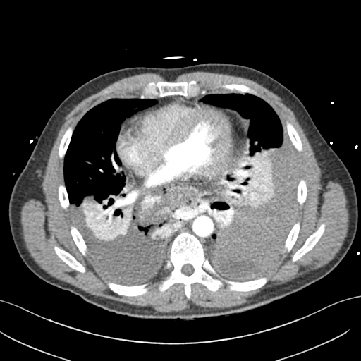 File:Boerhaave syndrome (Radiopaedia 39382-41661 B 1).png
