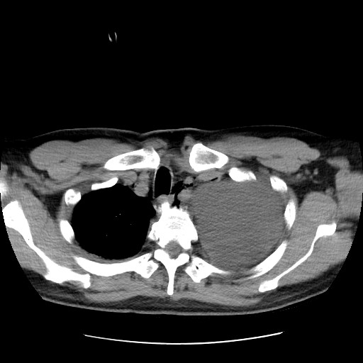 File:Boerhaave syndrome (Radiopaedia 59796-67310 Axial liver window 14).jpg