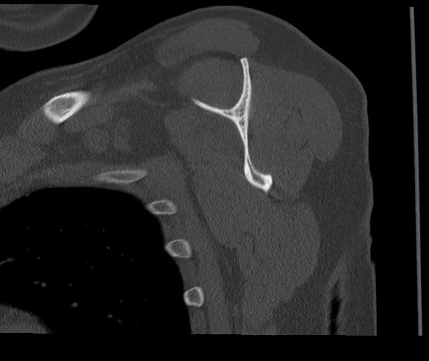Bony Bankart and Hill-Sachs lesions (Radiopaedia 33622-34727 Sagittal bone window 43).png