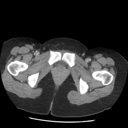 File:Borderline mucinous tumor (ovary) (Radiopaedia 78228-90808 A 140).jpg