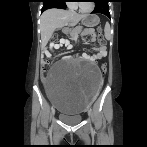 Borderline mucinous tumor (ovary) (Radiopaedia 78228-90808 C 23).jpg