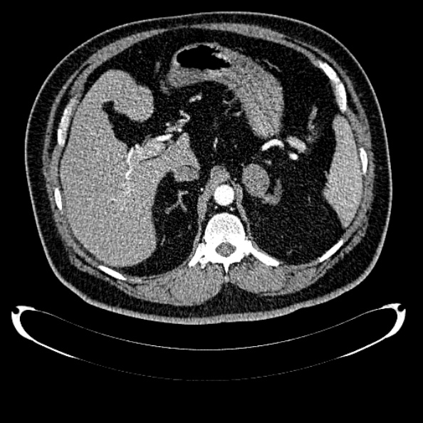 File:Bosniak renal cyst - type IV (Radiopaedia 24244-24518 B 82).jpg