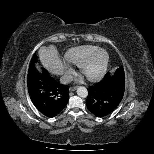Bovine aortic arch - right internal mammary vein drains into the superior vena cava (Radiopaedia 63296-71875 A 109).jpg