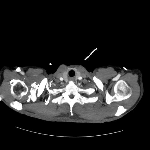 Bovine arch (Radiopaedia 27455-27654 C+ arterial phase 3).jpg