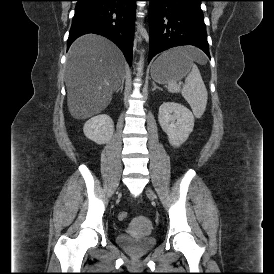 Bowel and splenic infarcts in acute lymphocytic leukemia (Radiopaedia 61055-68913 B 39).jpg