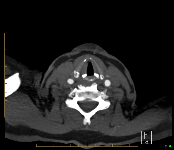 Brachiocephalic trunk stenosis (Radiopaedia 87242-103519 A 107).jpg