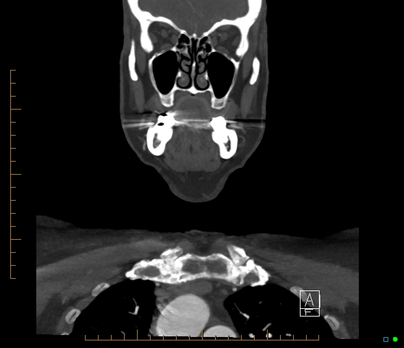 Brachiocephalic trunk stenosis (Radiopaedia 87242-103519 B 16).jpg