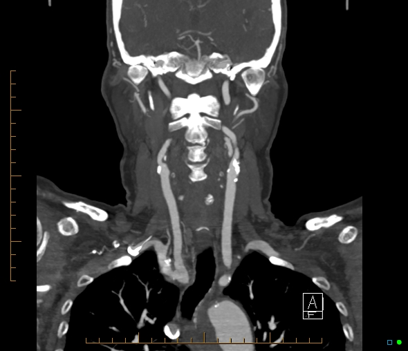 Brachiocephalic trunk stenosis (Radiopaedia 87242-103519 B 39).jpg
