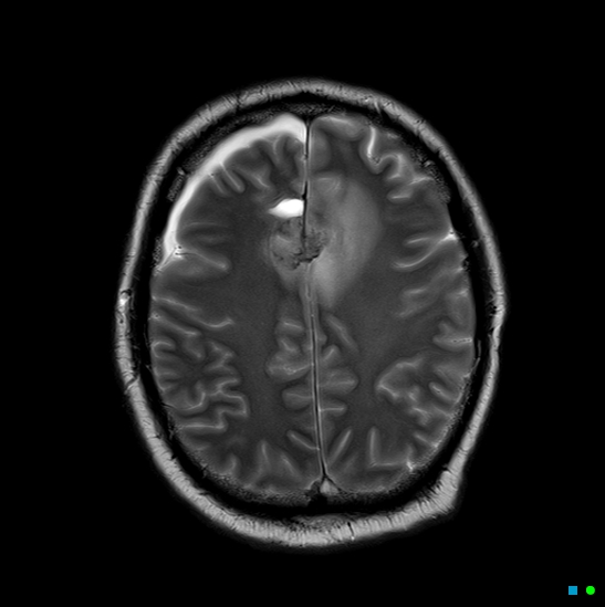 File:Brain death on MRI and CT angiography (Radiopaedia 42560-45689 Axial T2 23).jpg
