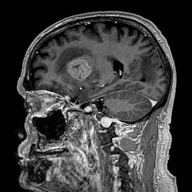 Brain metastases from lung cancer (Radiopaedia 83839-99028 Sagittal T1 C+ 22).jpg