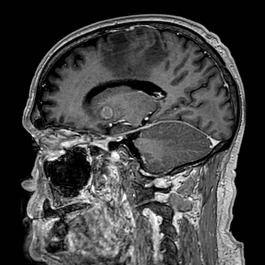 Brain metastases from lung cancer (Radiopaedia 83839-99028 Sagittal T1 C+ 39).jpg