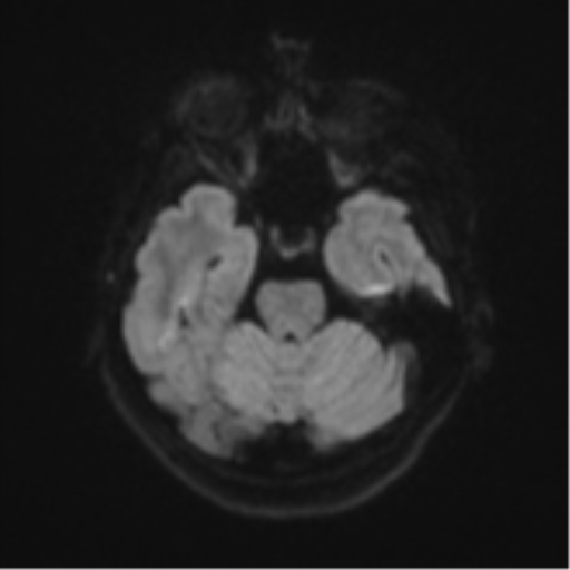 Brain metastasis (sarcoma) (Radiopaedia 47576-52209 Axial DWI 37).png
