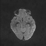 Brainstem glioma (Radiopaedia 67531-76922 Axial DWI 57).jpg