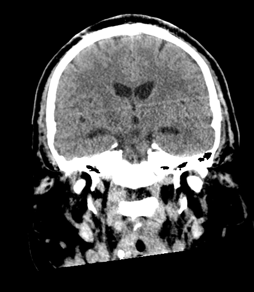 Brainstem hemorrhage (Radiopaedia 81294-94976 Coronal non-contrast 35).jpg