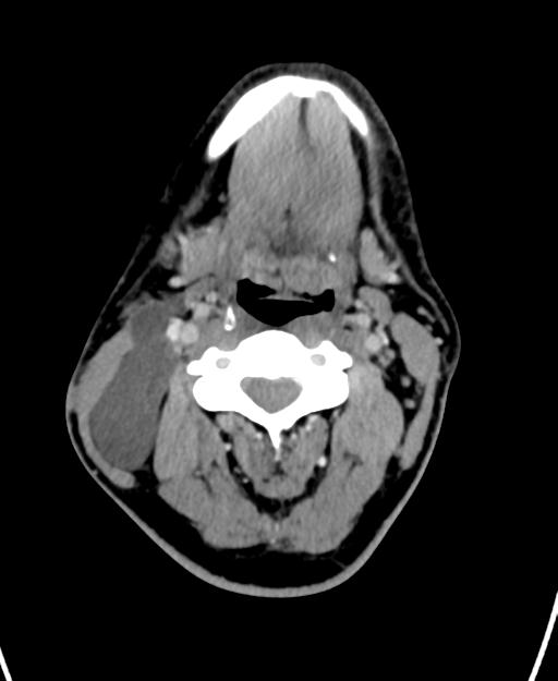 Branchial cleft cyst (Radiopaedia 31167-31875 Axial C+ delayed 27).jpg
