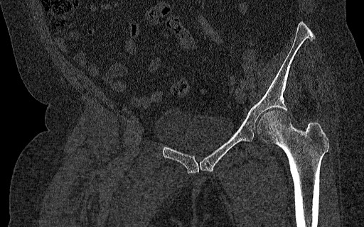 Breast carcinoma with pathological hip fracture (Radiopaedia 60314-67993 Coronal bone window 60).jpg