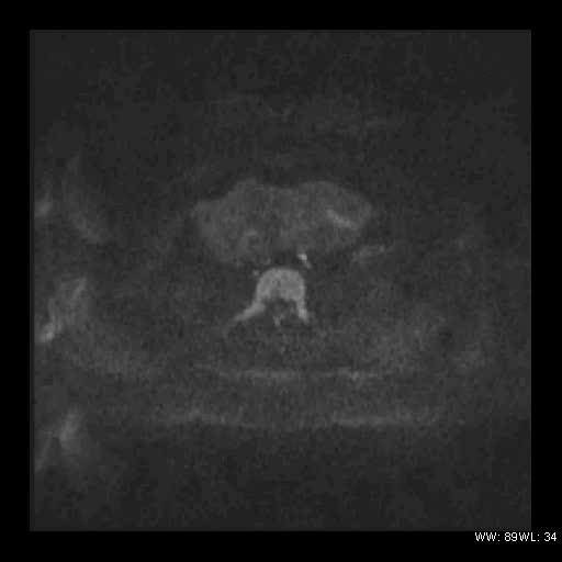 File:Broad ligament fibroid (Radiopaedia 49135-54241 Axial DWI 5).jpg