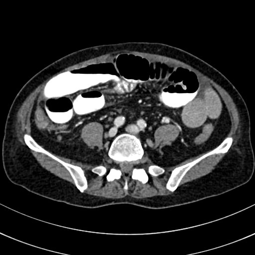File:Broad ligament hernia (Radiopaedia 84802-100276 A 74).jpg