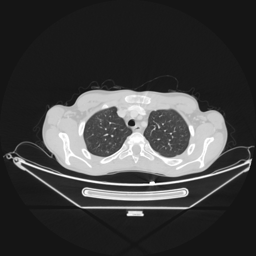 Bronchial carcinoid tumor (Radiopaedia 57187-64090 Axial lung window 13).jpg