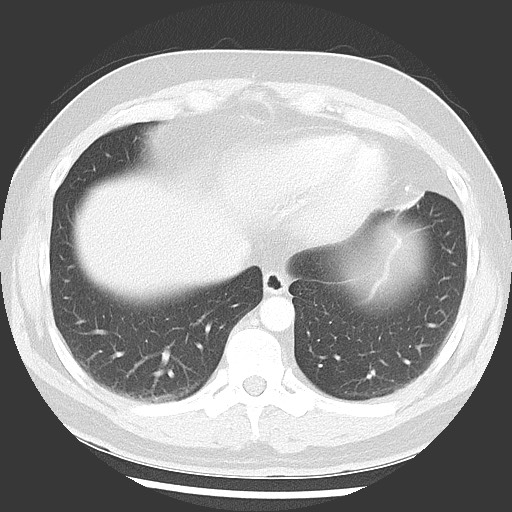Bronchial carcinoid tumor (Radiopaedia 67377-76764 Axial lung window 48).jpg
