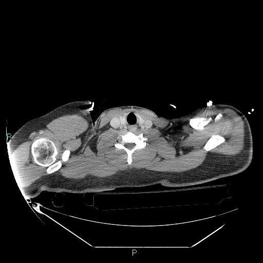 Bronchial carcinoid tumor (Radiopaedia 78272-90870 C 2).jpg