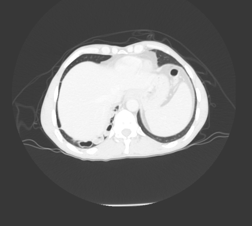 File:Bronchiectasis in Crohn disease (Radiopaedia 60311-67977 Axial lung window 26).jpg