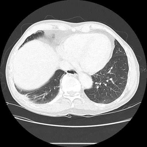 Bronchocele (Radiopaedia 17097-16795 Axial lung window 91).jpg
