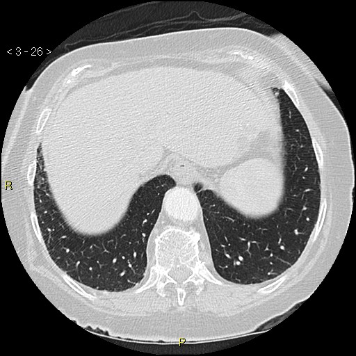 Bronchogenic carcinoma as an incidental finding (Radiopaedia 16453-16130 Axial lung window 26).jpg