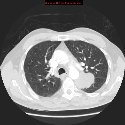 File:Bronchogenic carcinoma brain metastasis (Radiopaedia 9286-105832 Axial lung window 12).jpg