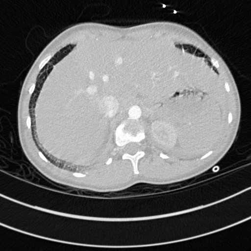 Bronchogenic cyst (Radiopaedia 77801-90071 Axial lung window 80).jpg