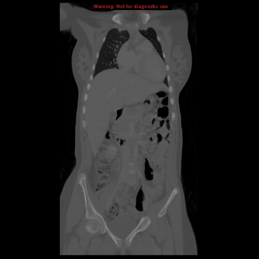 File:Brown tumor (Radiopaedia 12318-12596 D 26).jpg