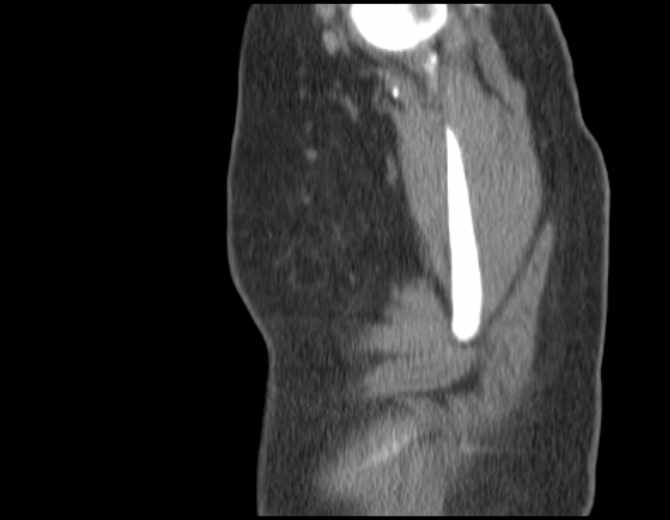 File:Brown tumors compressing the spinal cord (Radiopaedia 68442-77988 B 5).jpg