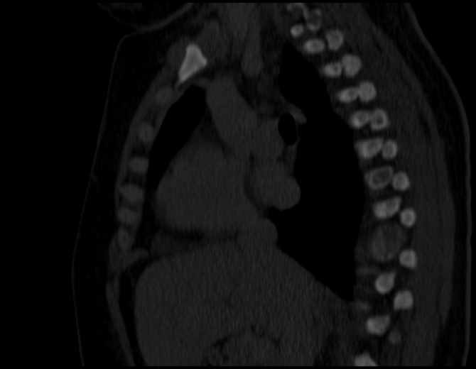 Brown tumors compressing the spinal cord (Radiopaedia 68442-77988 Sagittal bone window 26).jpg