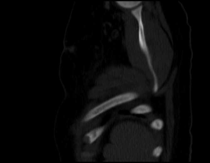 Brown tumors compressing the spinal cord (Radiopaedia 68442-77988 Sagittal bone window 53).jpg