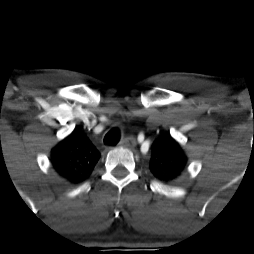 Buccal fat pad arteriovenous malformation (Radiopaedia 70936-81144 A 99).jpg