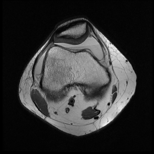 File:Bucket handle meniscus tear (Radiopaedia 56916-63751 Axial PD 5).jpg