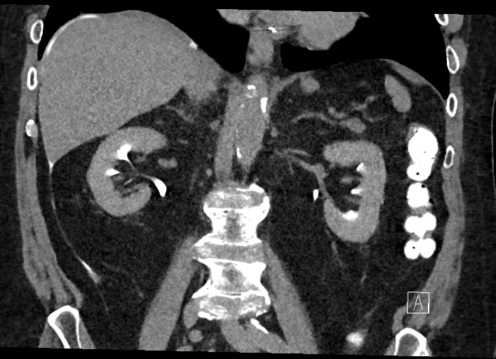Buried bumper syndrome - gastrostomy tube (Radiopaedia 63843-72577 Coronal Inject 79).jpg