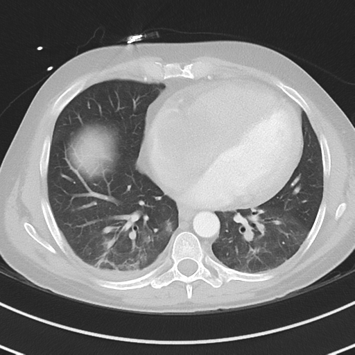 Burkitt lymphoma (Radiopaedia 34686-36121 Axial lung window 32).png