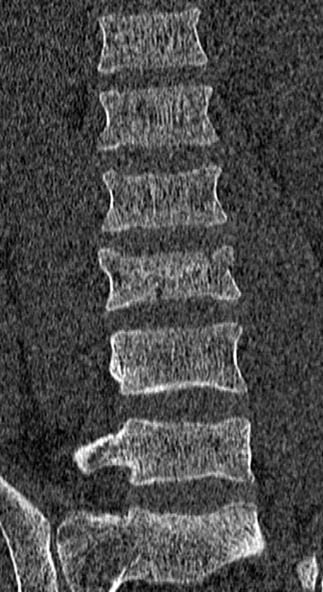 Burst fracture (Radiopaedia 53373-59357 Coronal bone window 31).jpg
