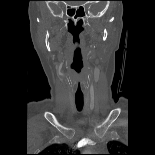 C1 anterior arch (plough) fracture - type 1 (Radiopaedia 76181-87720 Coronal bone window 75).jpg