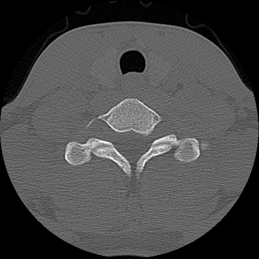 File:C5 facet fracture (Radiopaedia 58374-65499 Axial bone window 74).jpg