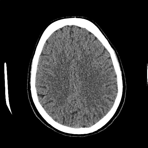 Calcified cerebral hydatid cyst (Radiopaedia 65603-74717 Axial non-contrast 52).jpg