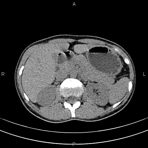 File:Calcified hepatic hydatid cyst (Radiopaedia 83870-99072 Axial non-contrast 59).jpg